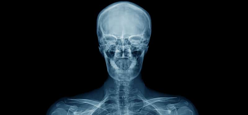 x ray of head and shoulders