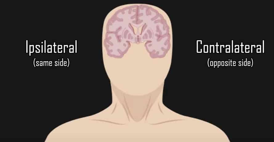 ipsilateral vs contralateral anatomic example